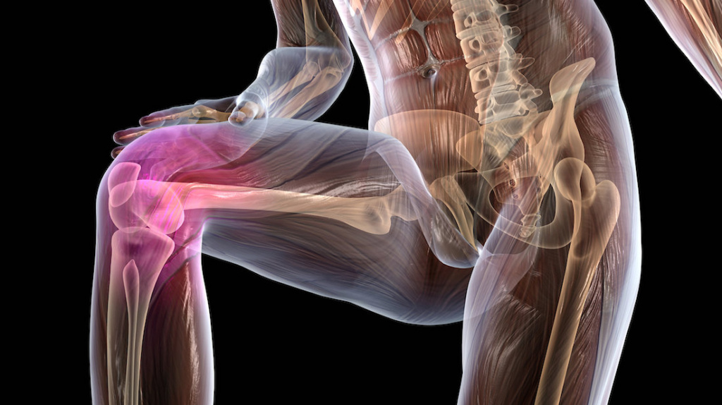 Medically 3D illustration showing painful osteoarthritic knee joint on black background